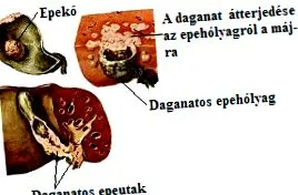 лікуванні паразитів