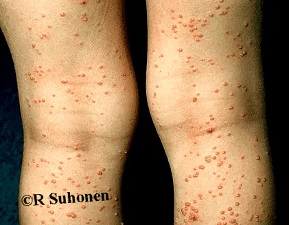 prevenirea metode