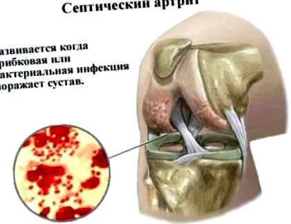 коліна гнійне