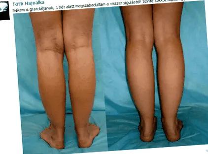 varicelor crema