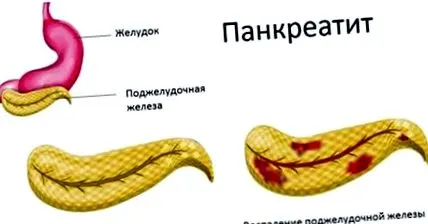 хроничен хроничен панкреатит