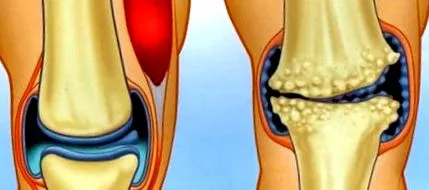 slăbești osteoartrita