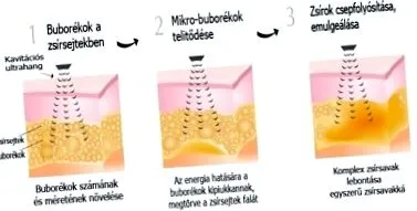 лечение кавитационно