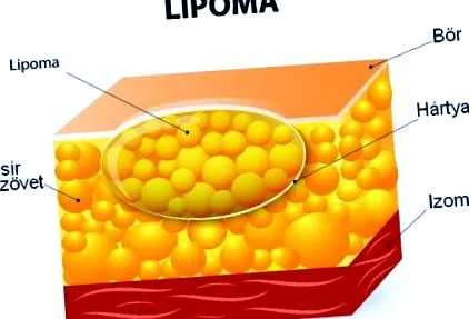 липома време диетата