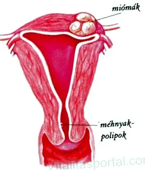 миома цервикални