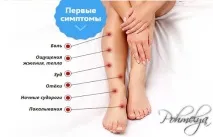 вени разширени
