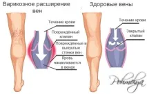 разширени вени вени