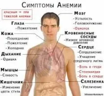 симптоми анемия
