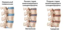 гръбначния стълб спондилит
