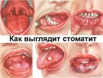 Білий наліт на гландах у дитини з і без температури грибок, пробки, крапки наліт