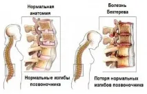 анкилозиращ детска