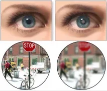 катаракта