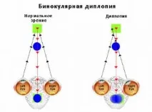 лекува диплопия