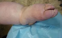 лечение лечение