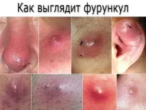Фурункул, код по мкб 10 абсцедуючого та інших видів на обличчі фурункул
