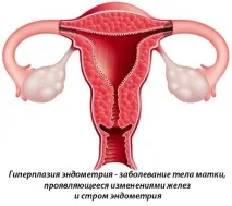 гіперплазія