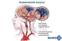 Ішемія головного мозку (хронічна), що це таке ішемічна атака головного