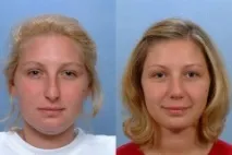 индикации инжекционна