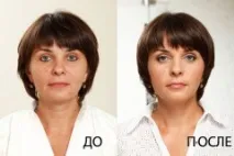 ринопластика инжекционна