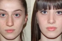 ринопластика индикации