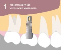 москва имплантация