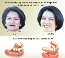 Імплантація зубів у Харкові зубів