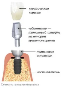 Імплантація зубів у Харкові Харкові