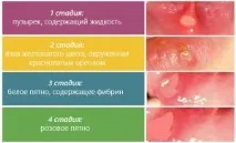 Як лікувати герпес у горлі у дитини горлі