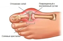 Як лікувати відкладення солей у суглобах, БУДИНОК НАШОЇ МРІЇ суглобах