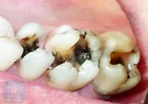 лечение кариес зъбите венците