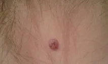 невус