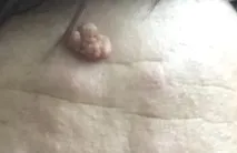 невус