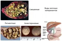 медицина жлъчката