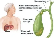 жлъчния камъни