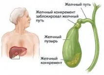 жлъчката медицина
