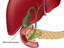 Камені у підшлунковій залозі симптоми хвороби камені