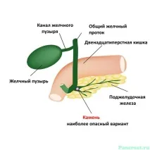 Камені у підшлунковій залозі симптоми хвороби підшлунковій