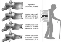 стълб последици