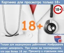 Клініка зовнішнього кишкового нориці зовнішнього
