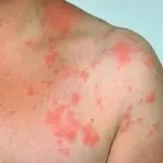 тялото херпес