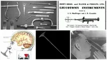 история lobotomy