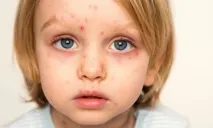 Лімфовузли при вітрянці чому вони збільшуються, як це проявляється і лікується вони
