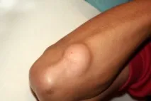 липома мастна тъкан