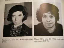 малко lobotomy