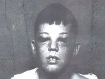 lobotomy lobotomy