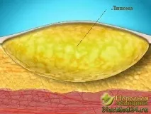 възможности тумори