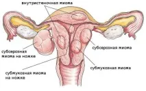 Мірена при клімаксі застосування спіралі мірена