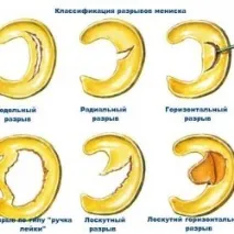 Меніск що таке, травми, операції на коліні меніск