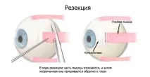 Операція з виправлення косоокості види, опис виправлення