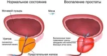 Залишкова сеча у сечовому міхурі у чоловіків та жінок сечовому